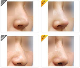 鼻子整形的分类及过程