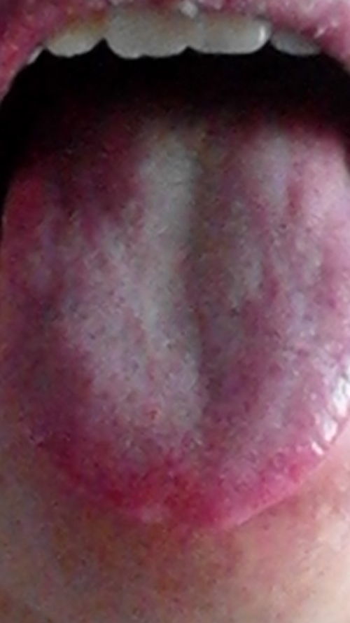 请帮看我舌苔照片辨别下我的体质 麻烦请懂行的人帮看下我舌苔照片 我目前体质到底如何 是寒症 湿症还是湿热等其他问题 早上第一次大便正常 早点后总腹泻一次 