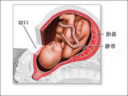 剖腹产手术过程详细图解 