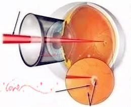 眼底微创 玻璃体视网膜手术 进入3D时代 