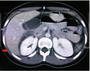 肝脏右上腹图片(肝区右上腹)