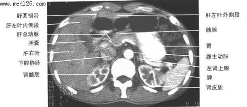 正常腹部CT解剖诊断图片,CT教学图解图谱,如何看怎么看,下载讲解CT 