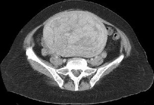 子宫肌瘤.CT,来源spiralCT 影像医学和核医学讨论版 